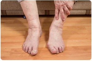 Close-up of swollen feet and ankles
