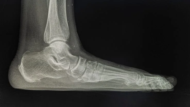 Foot MRI