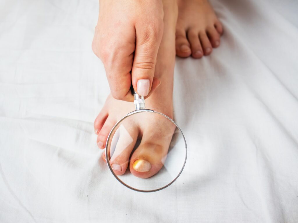 Person inspecting a toenail with magnifying glass