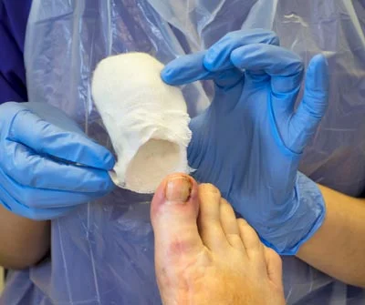 Doctor treating an ingrown toenail