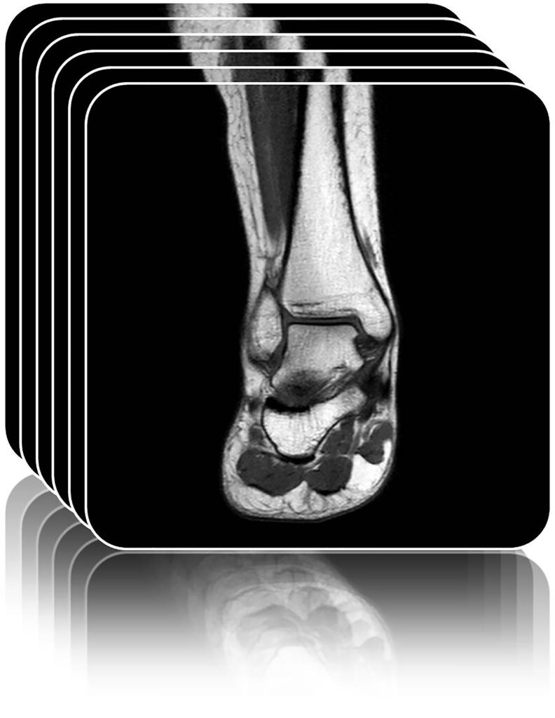 Ankle MRI